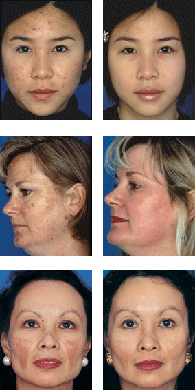 Obagi before and after results